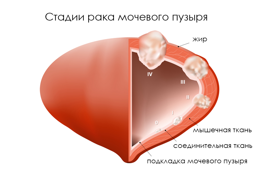 Лечение рак мочевого пузыря в россии
