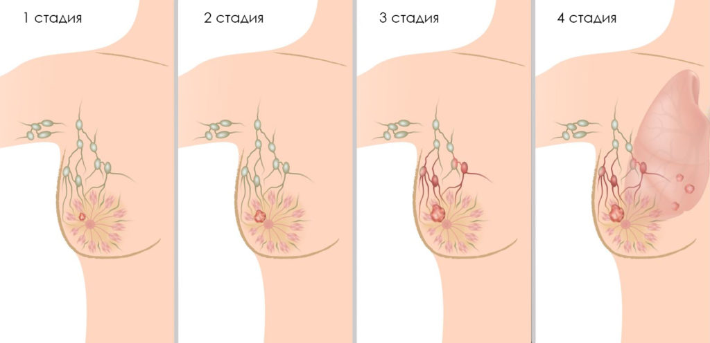 Лечение онкологии грудных желез в россии