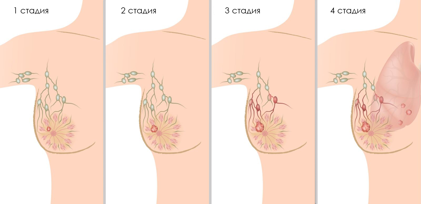 Рак молочной железы рисунок
