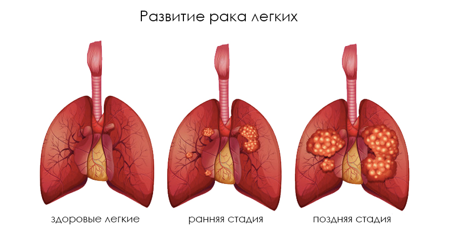 Лечение рака лёгких. Подробная информация для пациентов