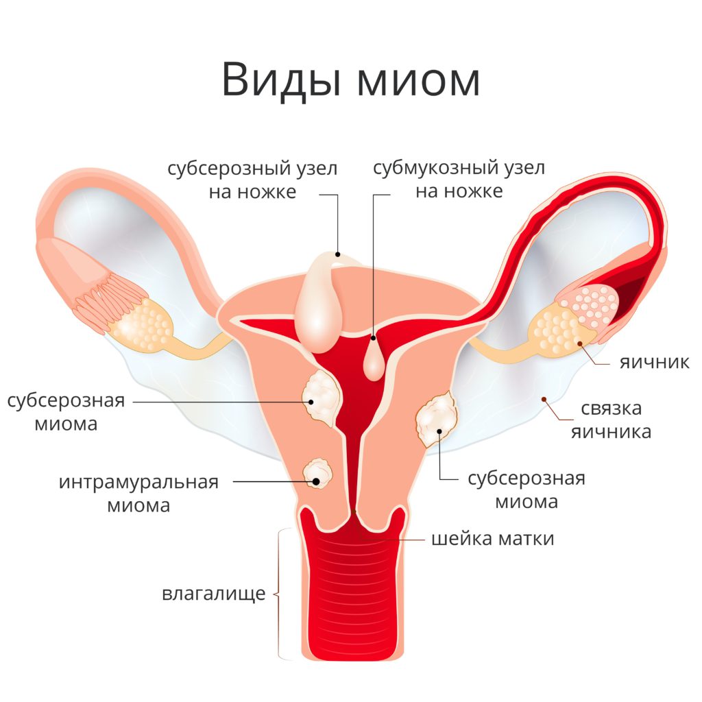 фибромиома матки