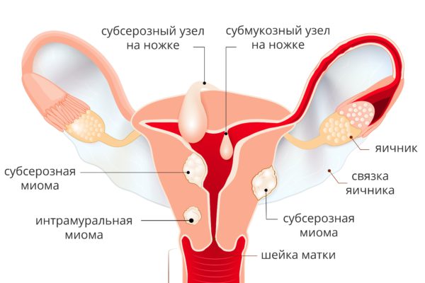 Фибромиома матки — доброкачественная опухоль